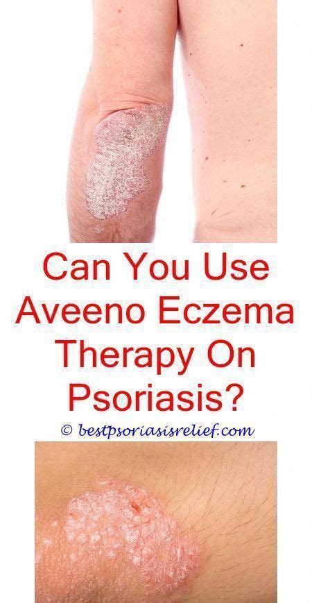 Pin By Renae Mobley Branstetter Woodh On Psoriasis Plaque Psoriasis