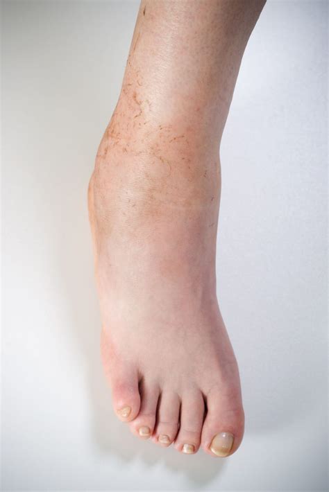 What Causes Foot Swelling Rnv Podiatry