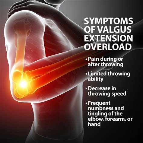 Valgus Extension Overload Florida Orthopaedic Institute