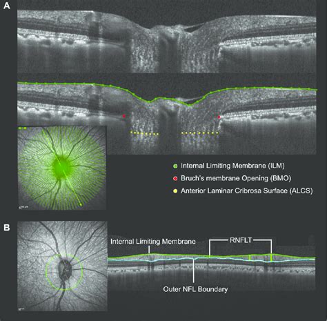Original And Delineated Spectral Domain Optical Coherence Tomography