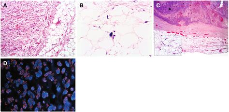 Well Differentiated And Dedifferentiated Liposarcoma A Hematoxylin And