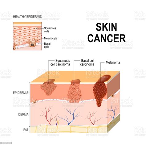 Skin Cancer Squamous Cell Carcinoma Basalcell Cancer And Melanoma Stock