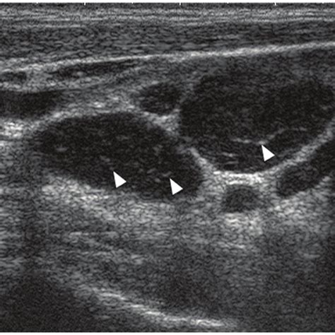 Pdf Ultrasound Of Malignant Cervical Lymph Nodes