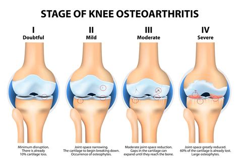 Osteoarthritis in the Knee | The Buxton Osteopathy Clinic