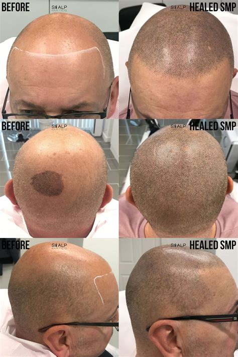 Miracle Hairline Recovery In Birmingham Uk Hair Tattoo Smp For