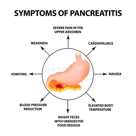 Pancreatitis Symptoms Stock Illustrations 28 Pancreatitis Symptoms