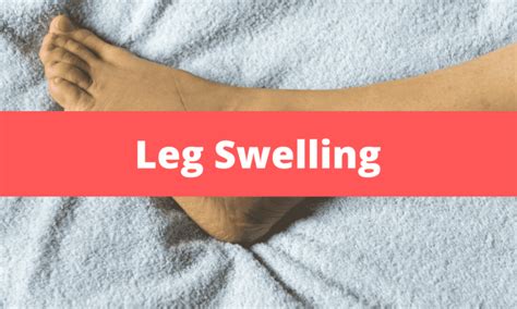 Leg Swelling Medical Junction
