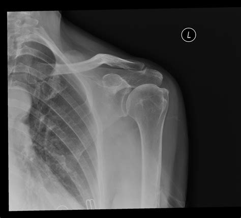 Acromioclavicular Joint Acj Injury Shoulder Conditions Hot Sex Picture