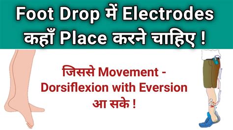 Foot Drop Electrode Placement Foot Drop Ka Ilaj Foot Drop Treatment