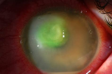 Corneal Ulcer Treatment Eye Drops