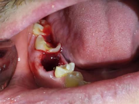 Hemorragia En Odontologia Qu Hacer Ante Una Hemorragia Bucodental