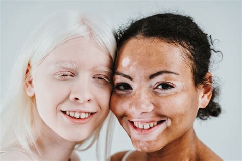 Albinizm Cz Ciowy Charakterystyka Przyczyny Leczenie