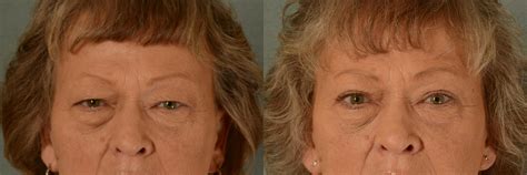 Eyelid Surgery Blepharoplasty Before And After Pictures Case 446
