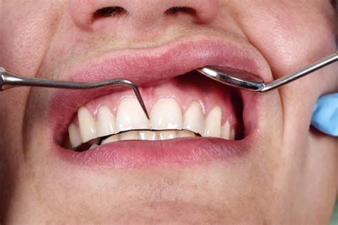 Lump On Gums Causes And Treatment And Natural Remedies