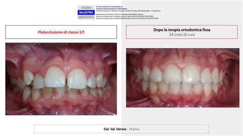 Studio Dentistico Balestro Malocclusione Di Classe 2 1
