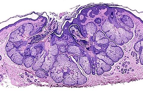 Histology Of Sebaceous Hyperplasia A Large Mature Sebaceous Gland