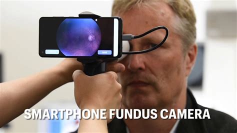 Smartphone Fundus Camera Youtube
