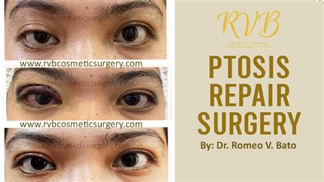 Ptosis Repair Surgery 1 Week After Results Youtube