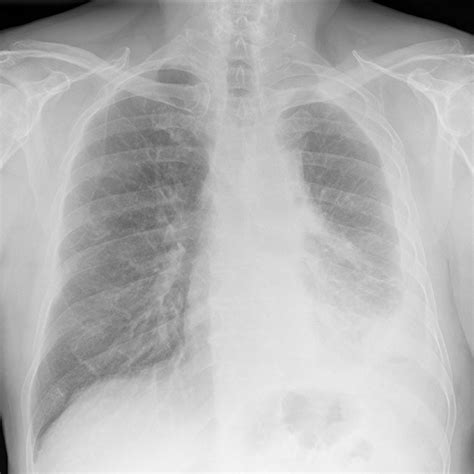 When mesothelioma affects the chest, the doctor may look inside the chest cavity with a special stage ii: Mesothelioma - What is Malignant Mesothelioma Cancer
