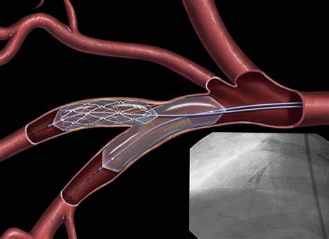 Сколько стоит поставить стент в сосуды сердца: особенности и цены | Что Картинка - Сколько стоит поставить стент в сосуды сердца: особенности и цены | Что
