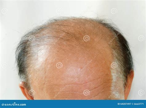 Bald Head Man Stock Image Image Of Medicine Baldness 64207497