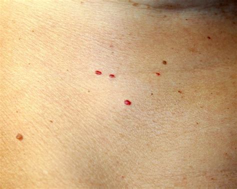 7 Reasons Your Skin Has Red Spots And Bumps Red Skin Spots Red Spots