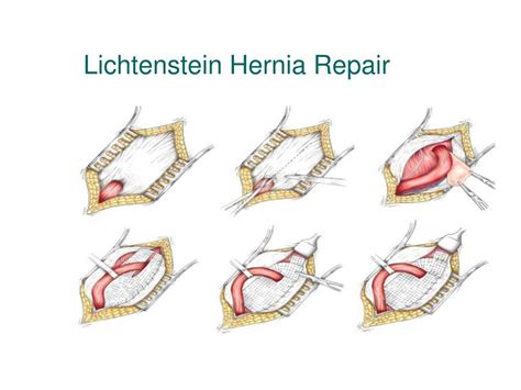 Lichtenstein Tensionfree Open Inguinal Hernia Repair