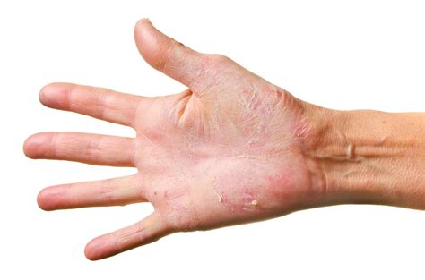 Dermatitis Herpetiformis Diagnosis With Skin Biopsy