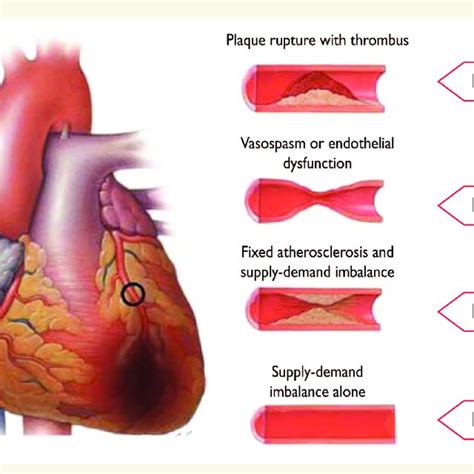 PDF Third Universal Definition Of Myocardial Infarction