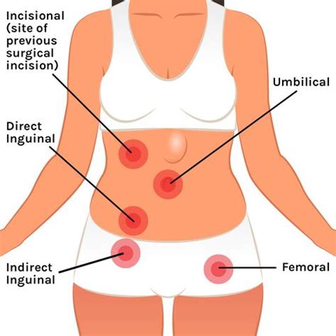 When stomach cancer does cause signs and symptoms, they can include: What Is a Hernia? - How To Tell If You Have A Hernia