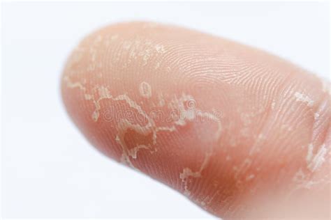 Peeling Skin On Hand And Fingers Desquamation Stock Photo Image Of