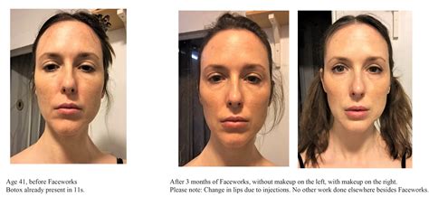Revitalize Your Face With Post Dysport Facial Exercises Fitluster