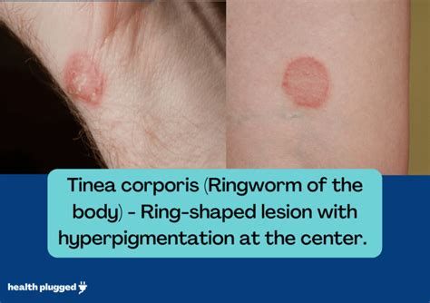Ringwormtinea Symptoms Pictures Diagnosis Treatment And Prevention
