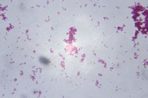 Gonorrhoea Could Become Untreatable Insight