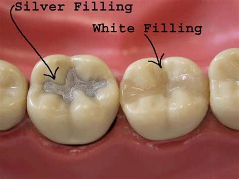 A simple filling may take as little as 20 minutes. White Fillings | Dr. David Chow Mississauga-Brampton ...