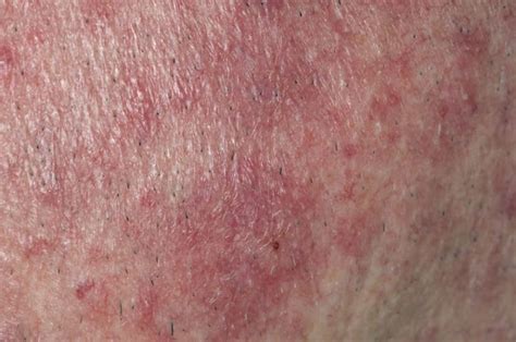 Oxymetazoline Reduces Facial Erythema In Moderate To Severe Rosacea