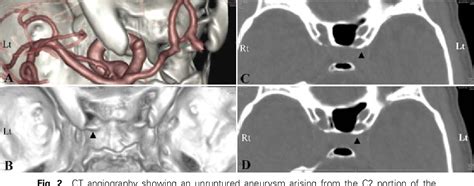 Figure 2 From Surgical Microanatomy Of The Anterior Clinoid Process For