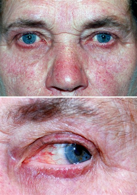 Ocular Rosacea An Underdiagnosed Cause Of Relapsing Conjunctivitis