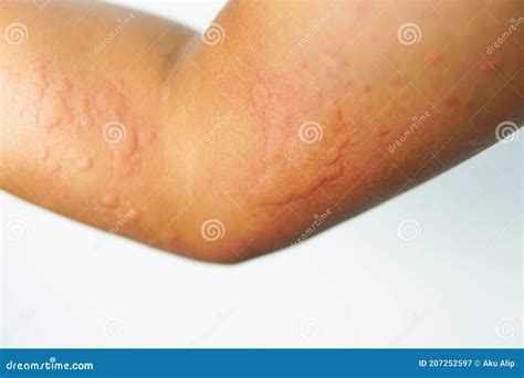Close Up Allergy Rash On Sensitive Skin Stock Image Image Of Medicine
