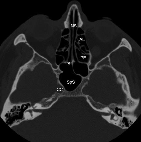 Together they form the 'bridge of the nose'. Sphenoid sinus CT : 네이버 블로그