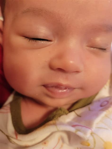 Little Red Spots On Both Sides Of Babys Cheeks Glow Community