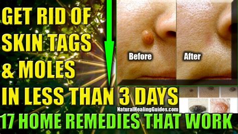 how to remove skin tags naturally get rid of skin moles fast 10 home remedies that work youtube