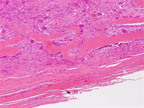 Pathology Outlines Giant Cell Tumor Of Soft Tissue