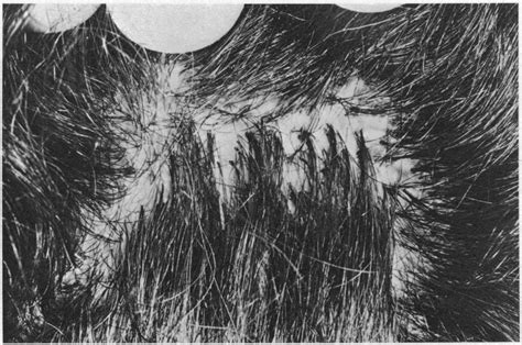 Clinical Appearance Of Scalp Showing Tufting Of Hairs Download