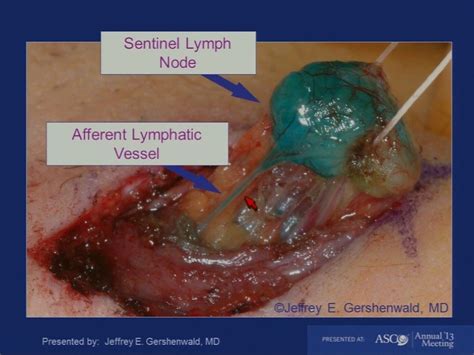 Lymph Node Surgery Sentinel Lymph Node Biopsy Biopsy Sentinel Lymph