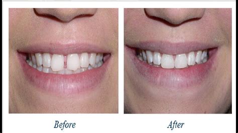 Though a gap between teeth, also known as a diastema, is not an uncommon occurrence, many people seek to rid themselves of this diastema the foolproof method for treating a gap between teeth is spring for braces. how to get rid of gap between front teeth without braces ...