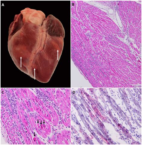 Myocarditis can be classified in a number of different ways. Gross, histological, and immunomicroscopic ...