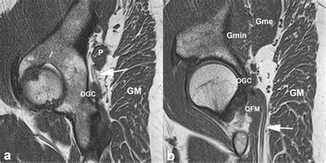Deep Gluteal Syndrome Anatomy Imaging And Management Of Sciatic