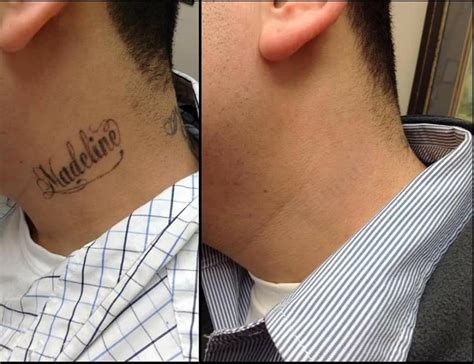 Before And After Photos Inkaway Laser Tattoo Removal