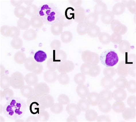 Esa Blood Sample Showing White Blood Cells Lymphocytes L And